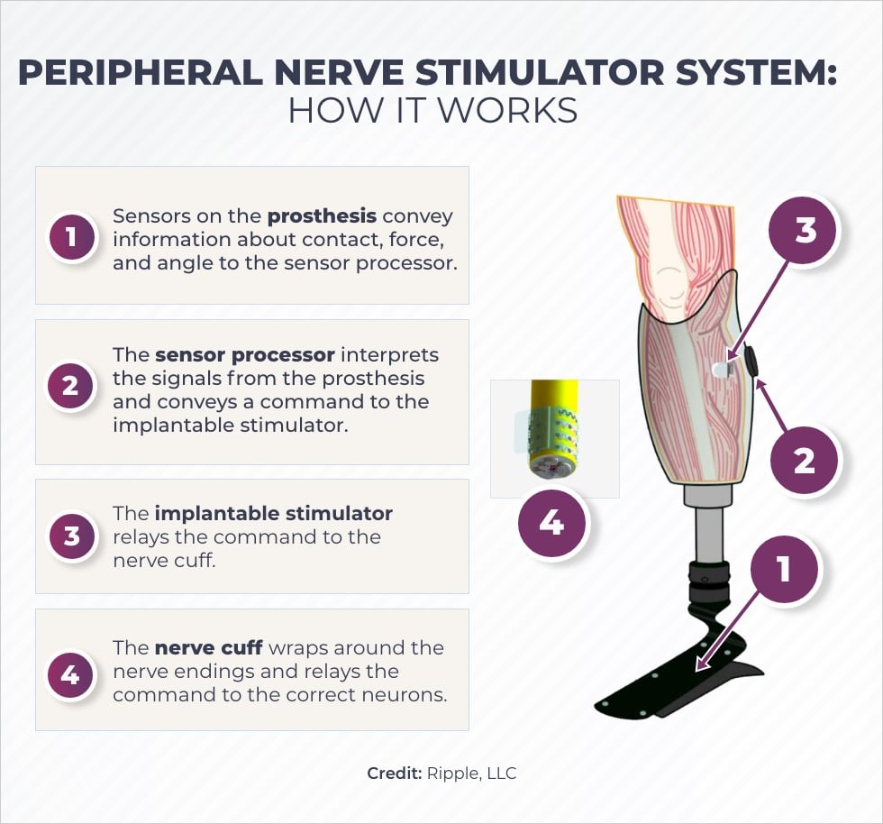 Illustration of a device that stimulates the nerves and alleviates phantom limb pain.