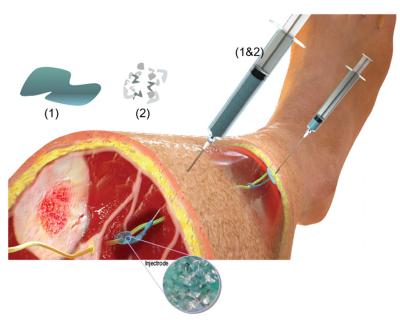 Image of a nerve stimulator, a kind of electrode, being applied. 